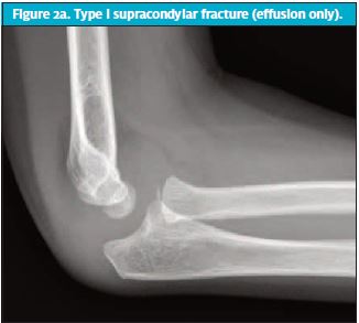 Pediatric Elbow Fractures 1