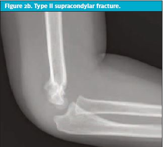 Pediatric Elbow Fractures 2