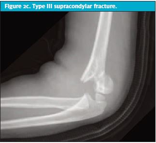 Pediatric Elbow Fractures 3