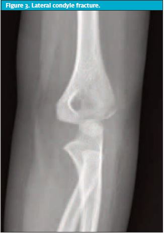 Lateral condyle fracture