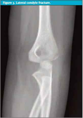 Lateral condyle fracture