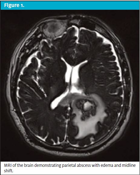 Figure 1 Brain Abscess in an Immunocompetent Patient
