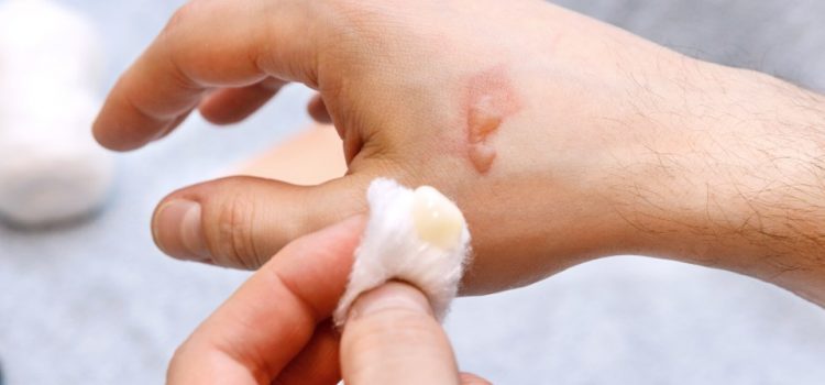 Management of Burn Blisters in Urgent Care