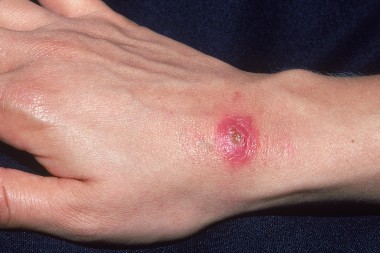 A 43-Year-Old Woman with a New Ulcer on One Hand