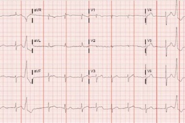 An 87-Year-Old Male with Chest Pain, SOB, and a History of Valvular AFib, Stroke, and Heart Failure