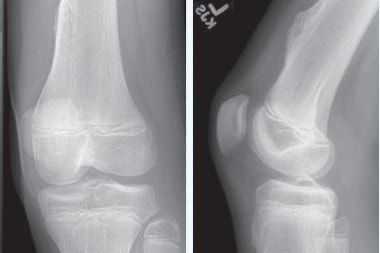 A 12-Year-Old Boy with Knee Pain After a Baseball Game