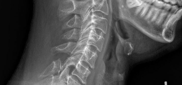 A 35-Year-Old with Neck Pain After an Auto Accident