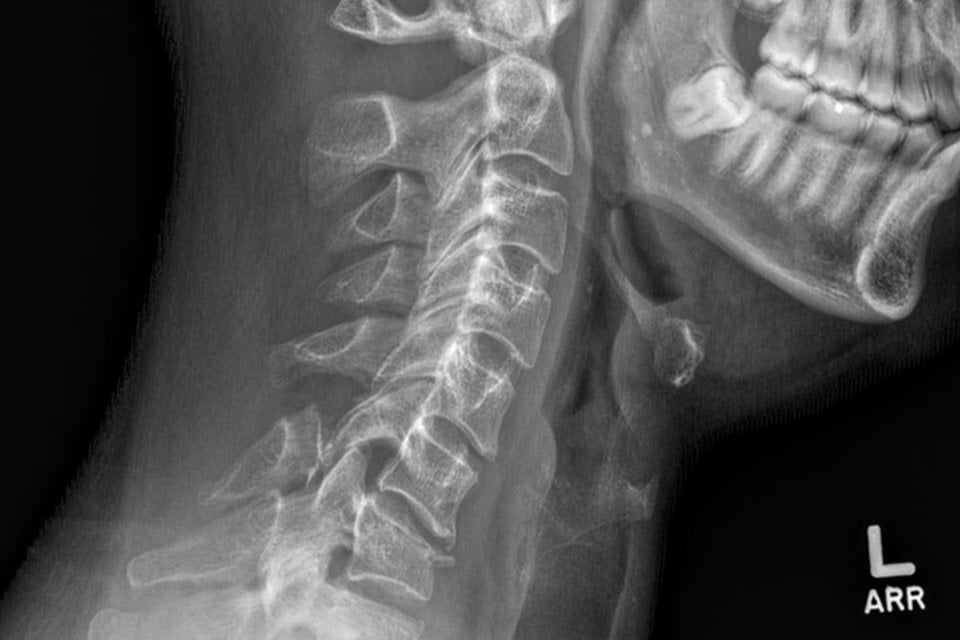 A 35-Year-Old with Neck Pain After an Auto Accident - Journal of Urgent ...