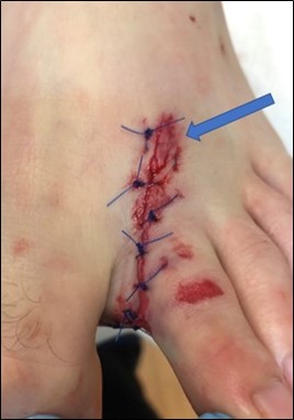 Parallel Laceration Repair 