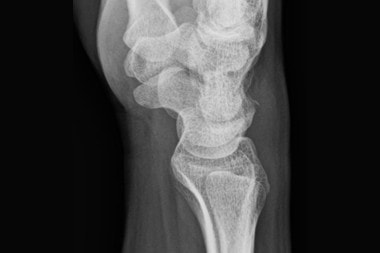 A 41-Year-Old with Dorsal Wrist Pain After a Slip-and-Fall