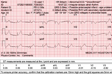 A 55-Year-Old Female with 1 Hour of Chest Pain