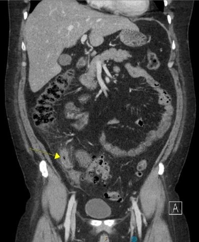 Figure 1. Obese patients with suspected appendicitis.