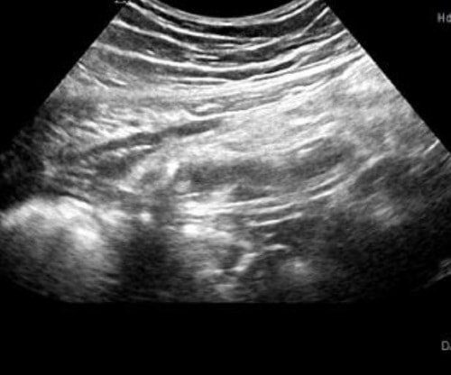 Figure 2. Adult patient with suspected acute appendicitis.