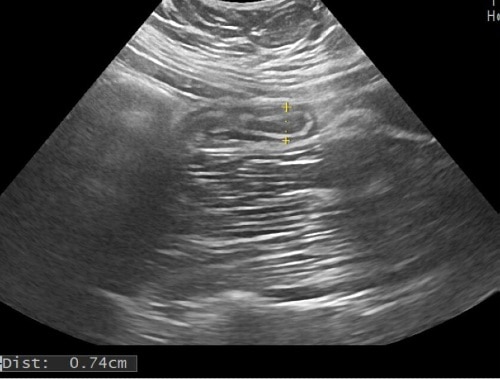 Figure 3. Pregnant patient with suspected appendicitis.