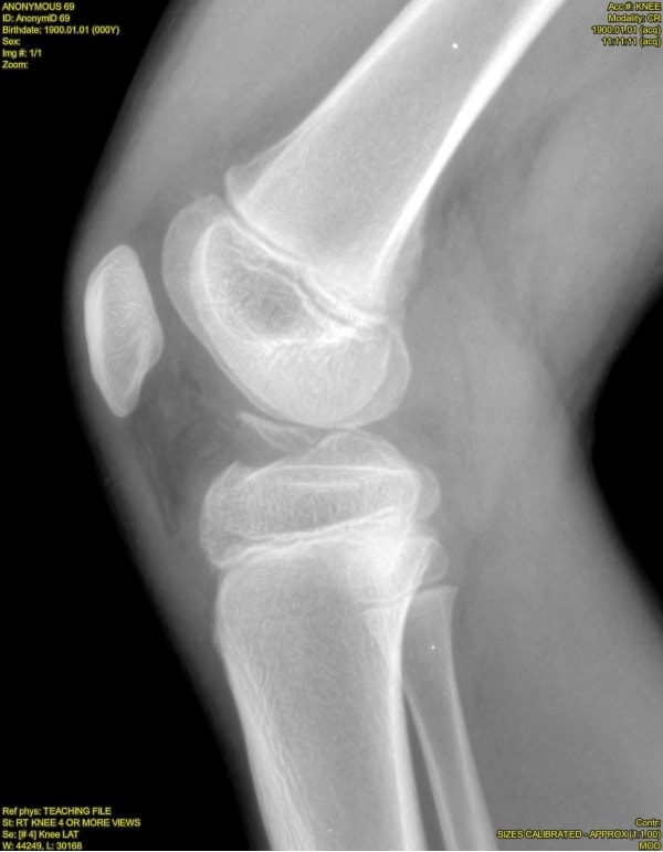 Displaced avulsion fracture of the tibial spine XR Image