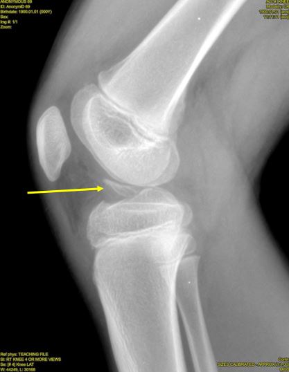 Displaced avulsion fracture of the tibial spine Resolution