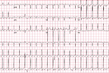 A 45-Year-Old Male with Palpitations