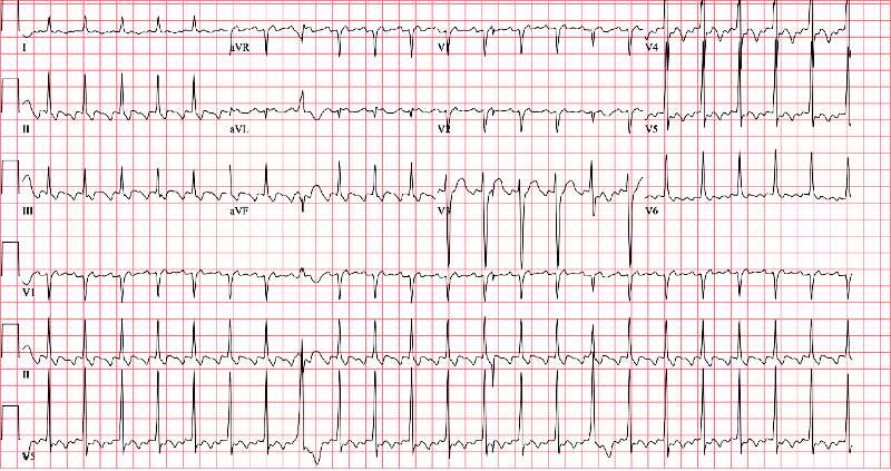 45-Year-Old Male with Palpitations