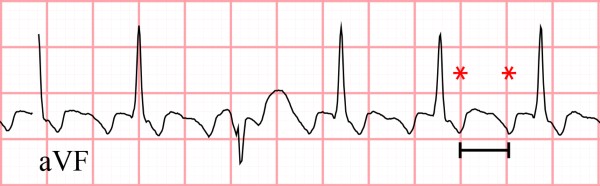 45-Year-Old Male with Palpitations