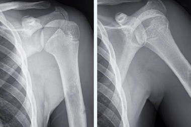 A 16-Year-Old Boy with Arm Pain After a Baseball Game