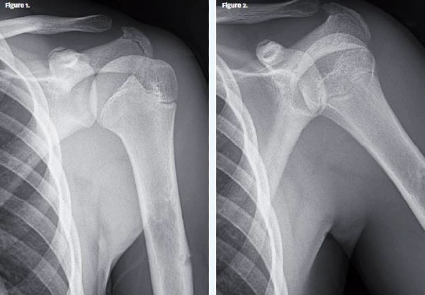 lytic diaphyseal lesion 