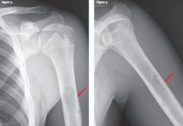 lytic diaphyseal lesion 