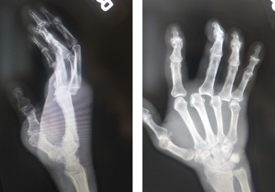 Metacarpophalangeal joint dislocations XR images