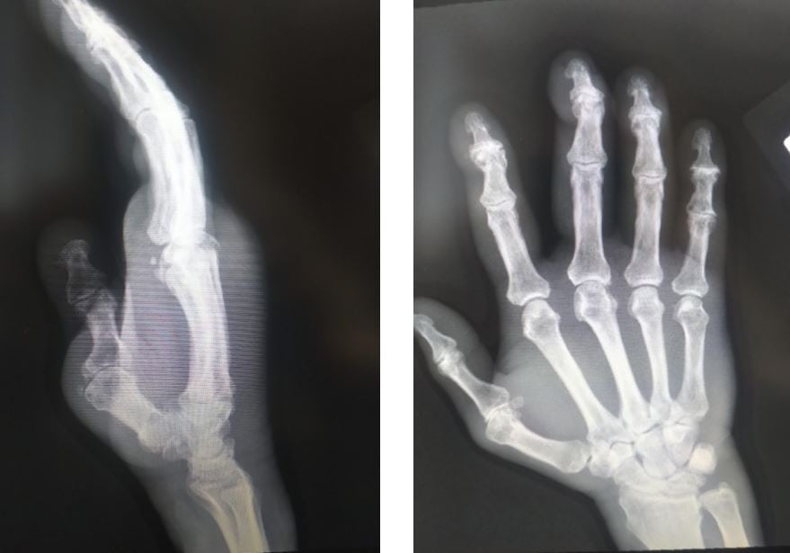 Metacarpophalangeal joint dislocations XR images