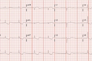 An 83-Year-Old Female with CHF, A-Fib, and New-Onset Confusion and Syncope