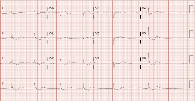 digoxin toxicity