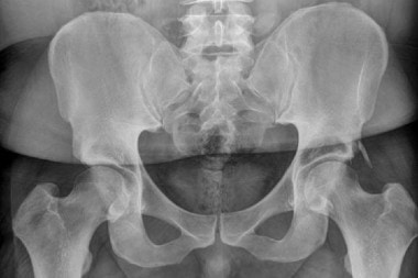 A 40-Year-Old with Back Pain After a Fall
