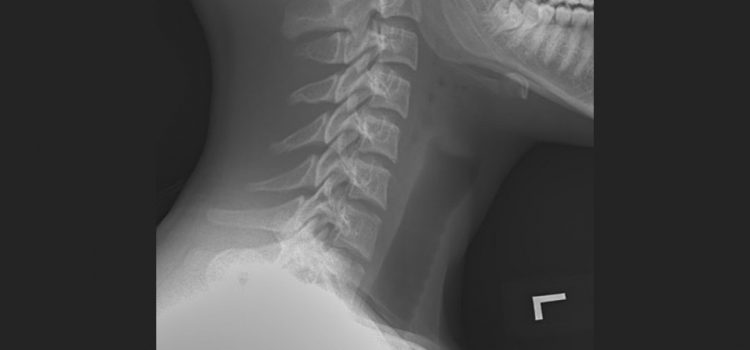 A 16-Year-Old Female with Neck Pain After Swallowing