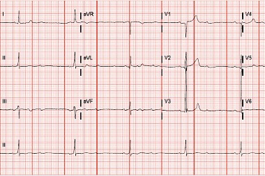 A 79-Year-Old Male with Left Shoulder Pain and a History of Hypertension and CAD