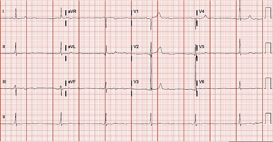 Second-degree atrioventricular block, 2:1 conduction