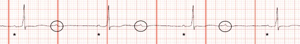 Second-degree atrioventricular block, 2:1 conduction