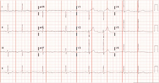 Second-degree atrioventricular block, 2:1 conduction