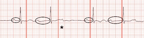 Ovals designate the progressively prolonging PR interval until a ventricular beat is dropped. The nonconducted P wave is indicated by the asterisk.