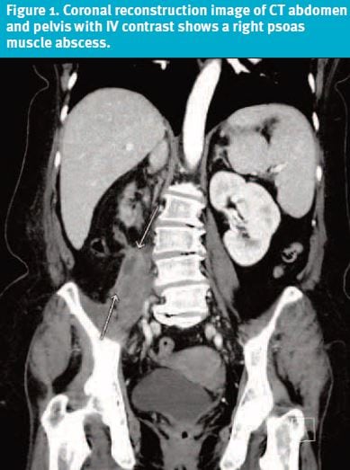 Psoas Abscess in Urgent Care