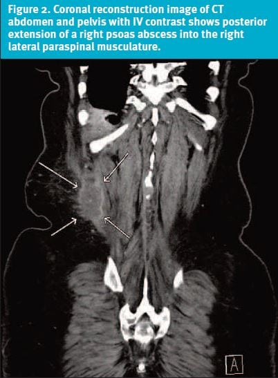 Psoas Abscess in Urgent Care