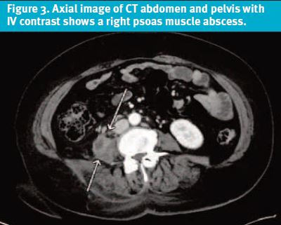 Psoas Abscess in Urgent Care