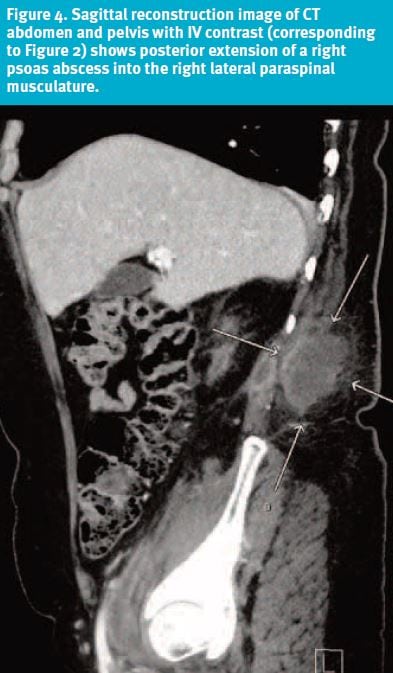 Psoas Abscess in Urgent Care