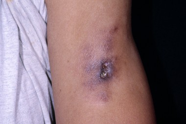A 41-Year-Old Woman with a History of SLE and Sudden-Onset Sores on Her Limbs