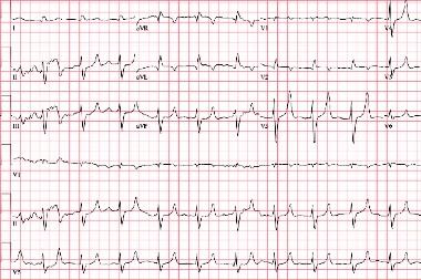 A 70-Year-Old Male Who Presents in a Confused State