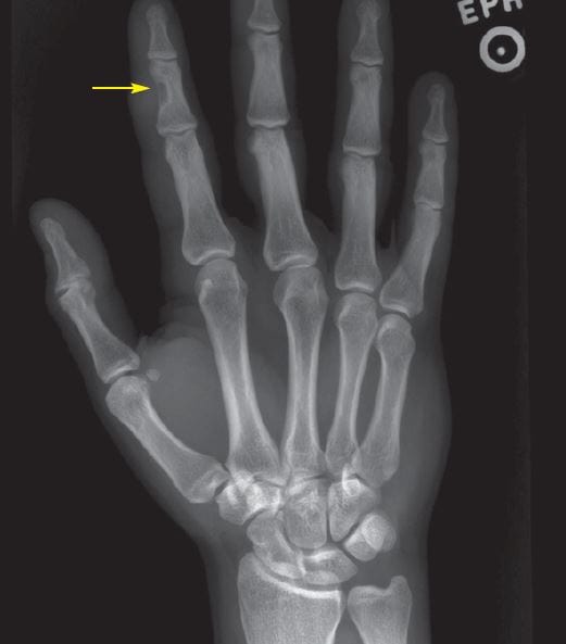 Soft Tissue Mass on Finger