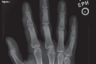 A 35-Year-Old Male with a Soft Tissue Mass on His Finger