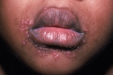 A 7-Year-Old Boy with New Facial Rash