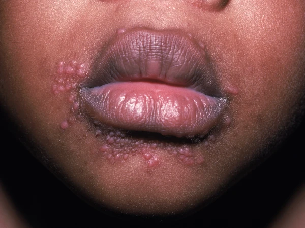 boy with new facial rash