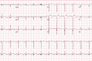 A 52-Year-Old Male with Shortness of Breath and a History of Multiple Cardiologic Issues