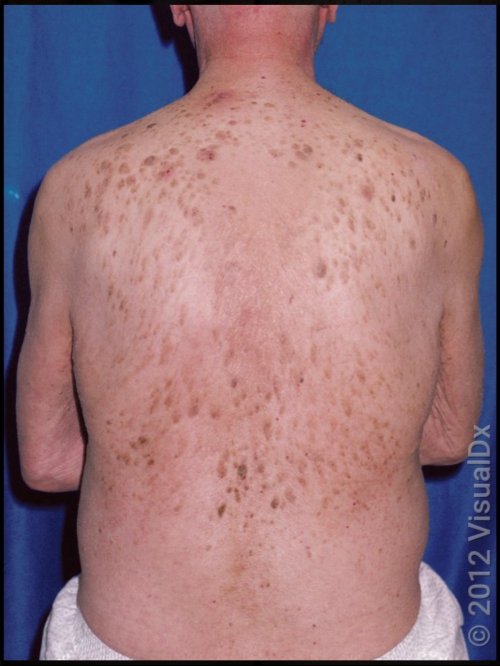 Paraneoplastic pruritus. Itch associated with cancer