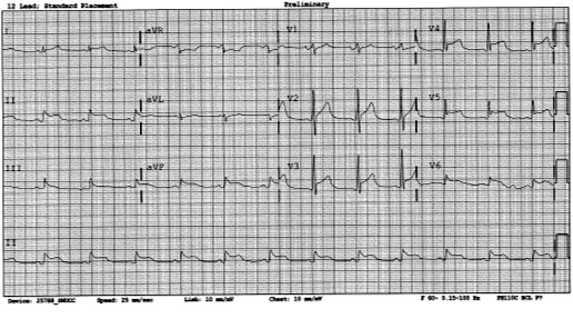 EKG of patient with severe illness in urgent care